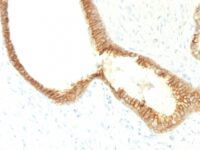 FFPE human prosate carcinoma sections stained with 100 ul anti-E-Cadherin / CD324 (clone CDH1/1525) at 1:300. HIER epitope retrieval prior to staining was performed in 10mM Citrate, pH 6.0.